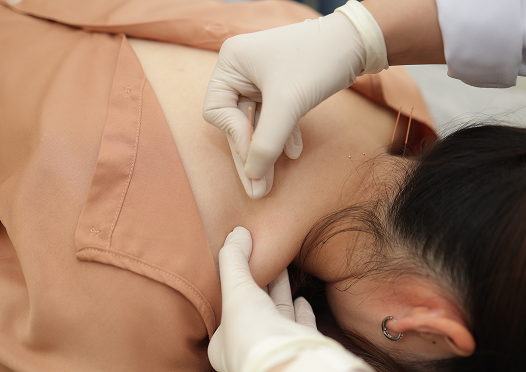  การฝังเข็ม 