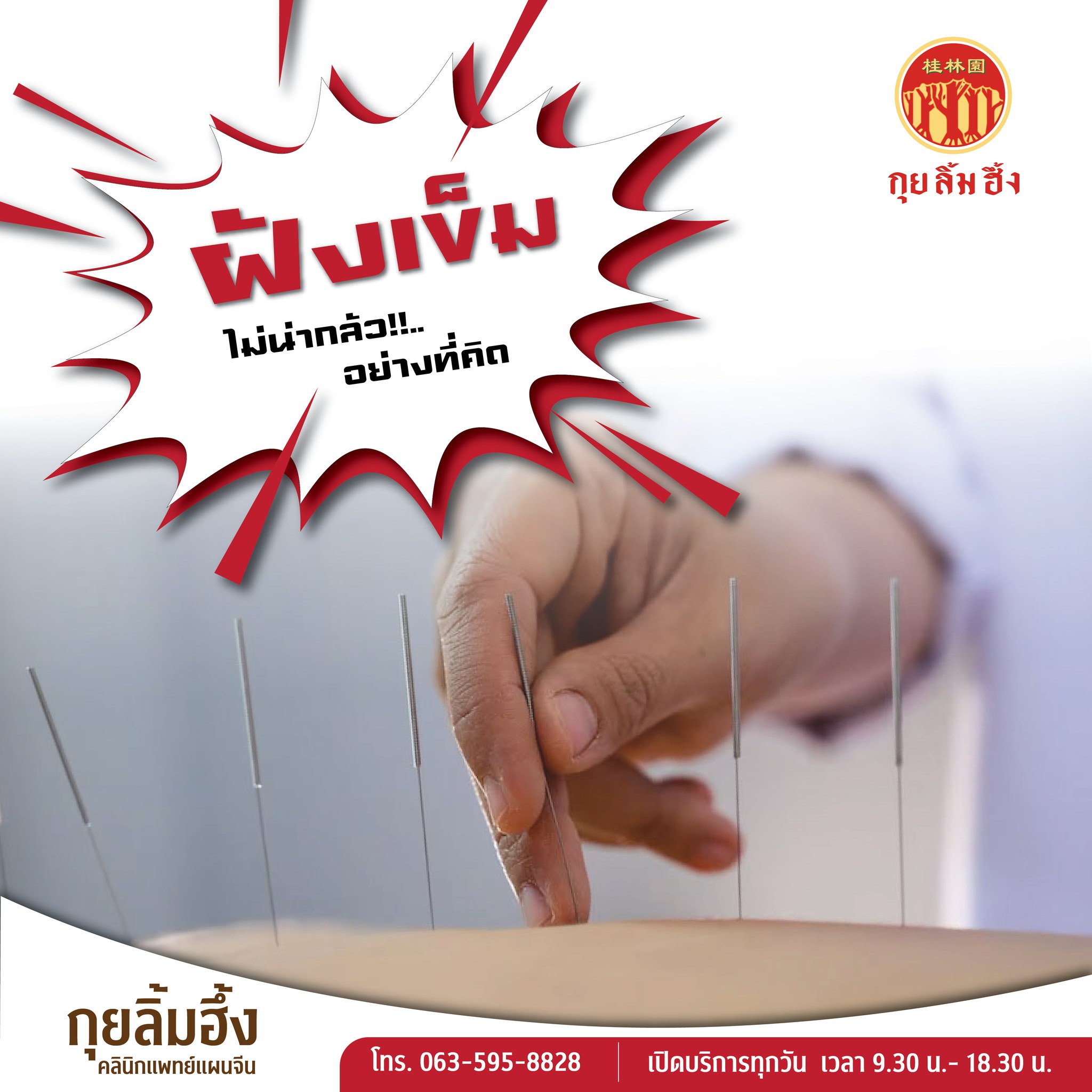 ฝังเข็ม ไม่น่ากลัวอย่างที่คิด